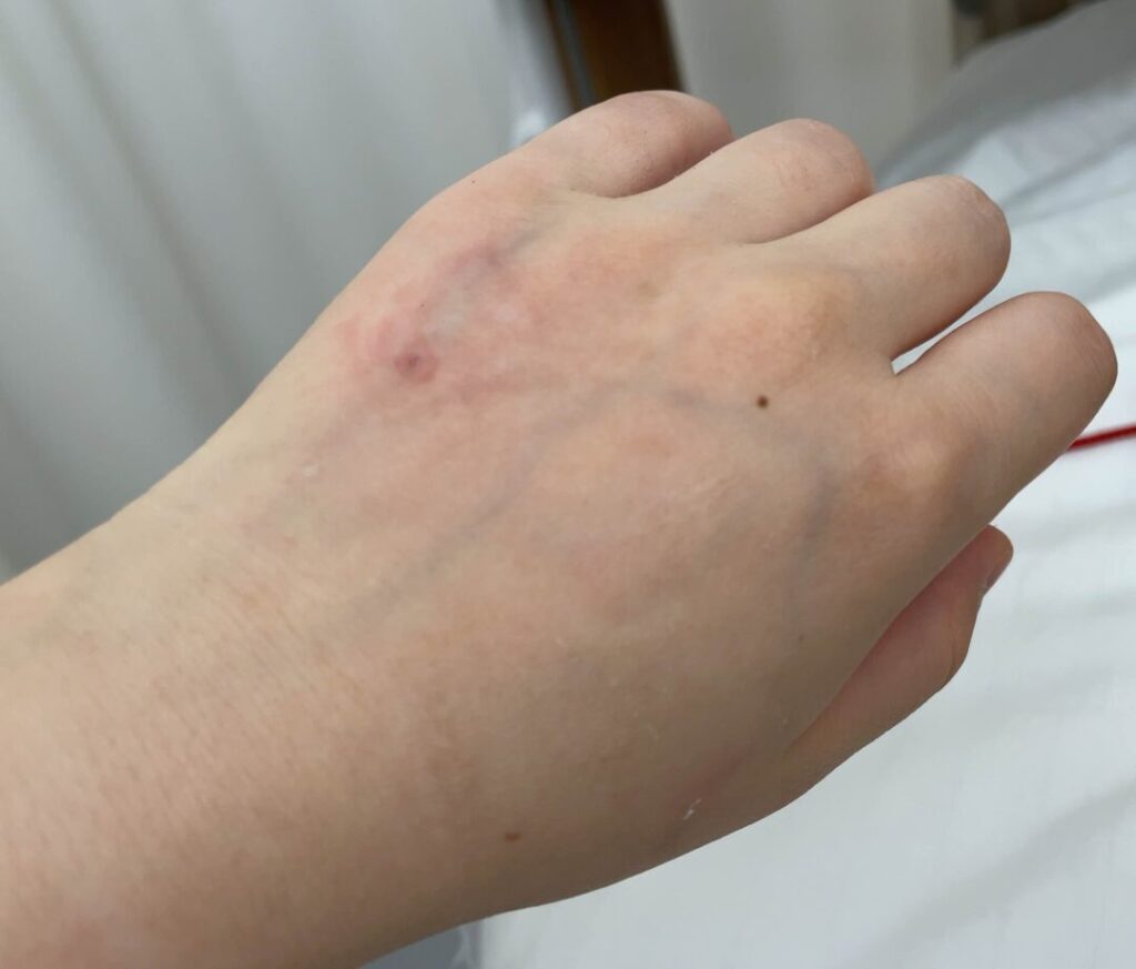 正中頸嚢胞手術/手の甲の点滴抜いた後