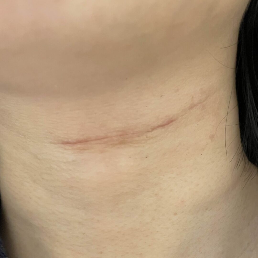 手術３ヶ月後の写真