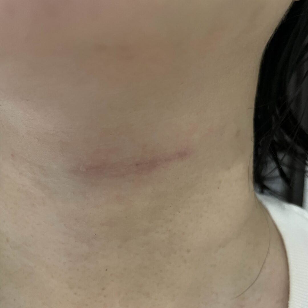 手術６ヶ月後の写真