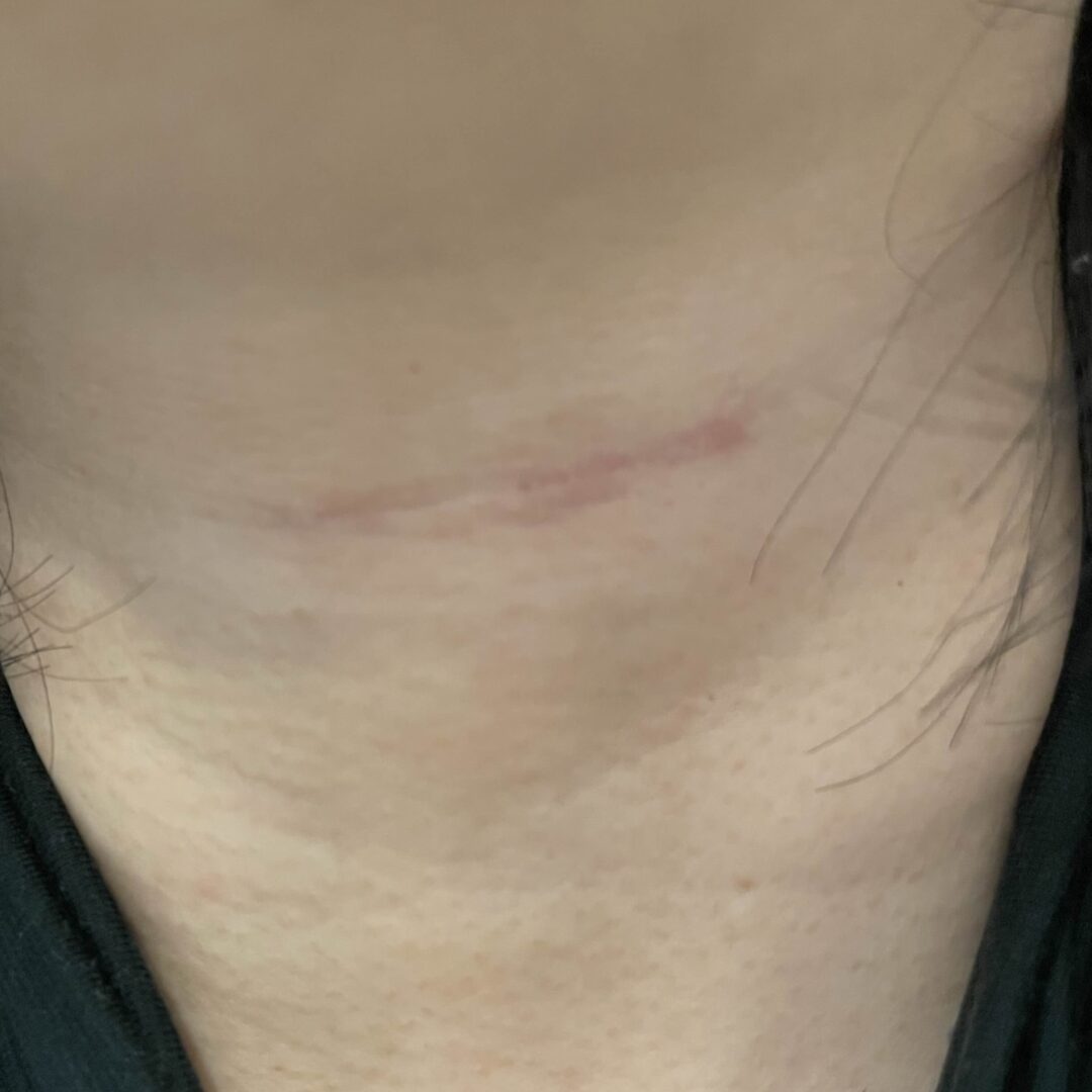 手術１年後の写真